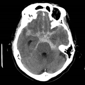 頭部CT（くも膜下出血）