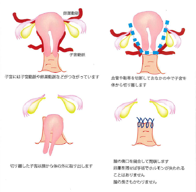 術 子宮 いつまで 摘出 全 後 痛み