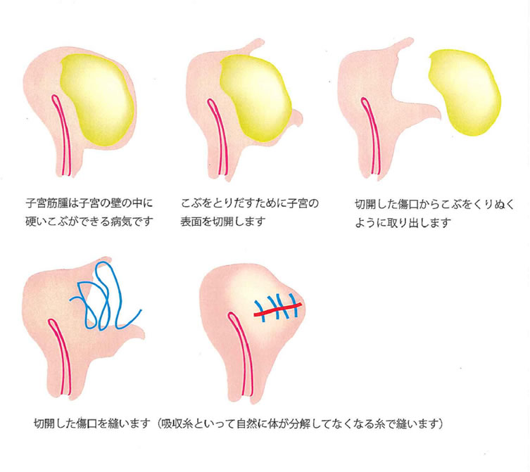 後 子宮 の 手術 生活 筋腫 子宮筋腫の腹腔鏡下手術～その利点と難点 後編