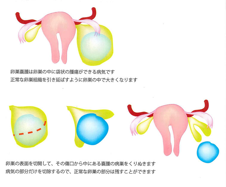 再発 卵巣 嚢腫