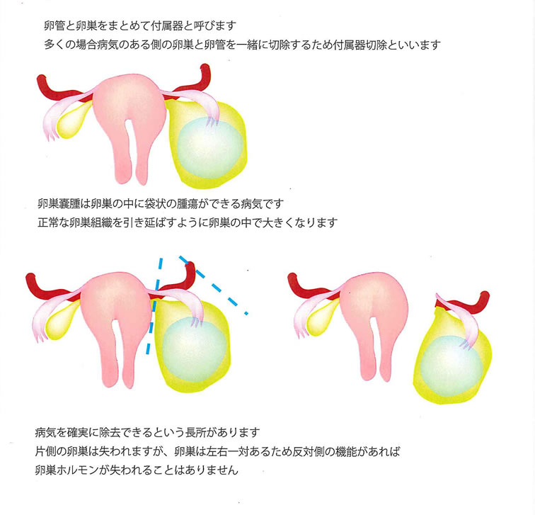 卵巣 摘出 後 の 体調