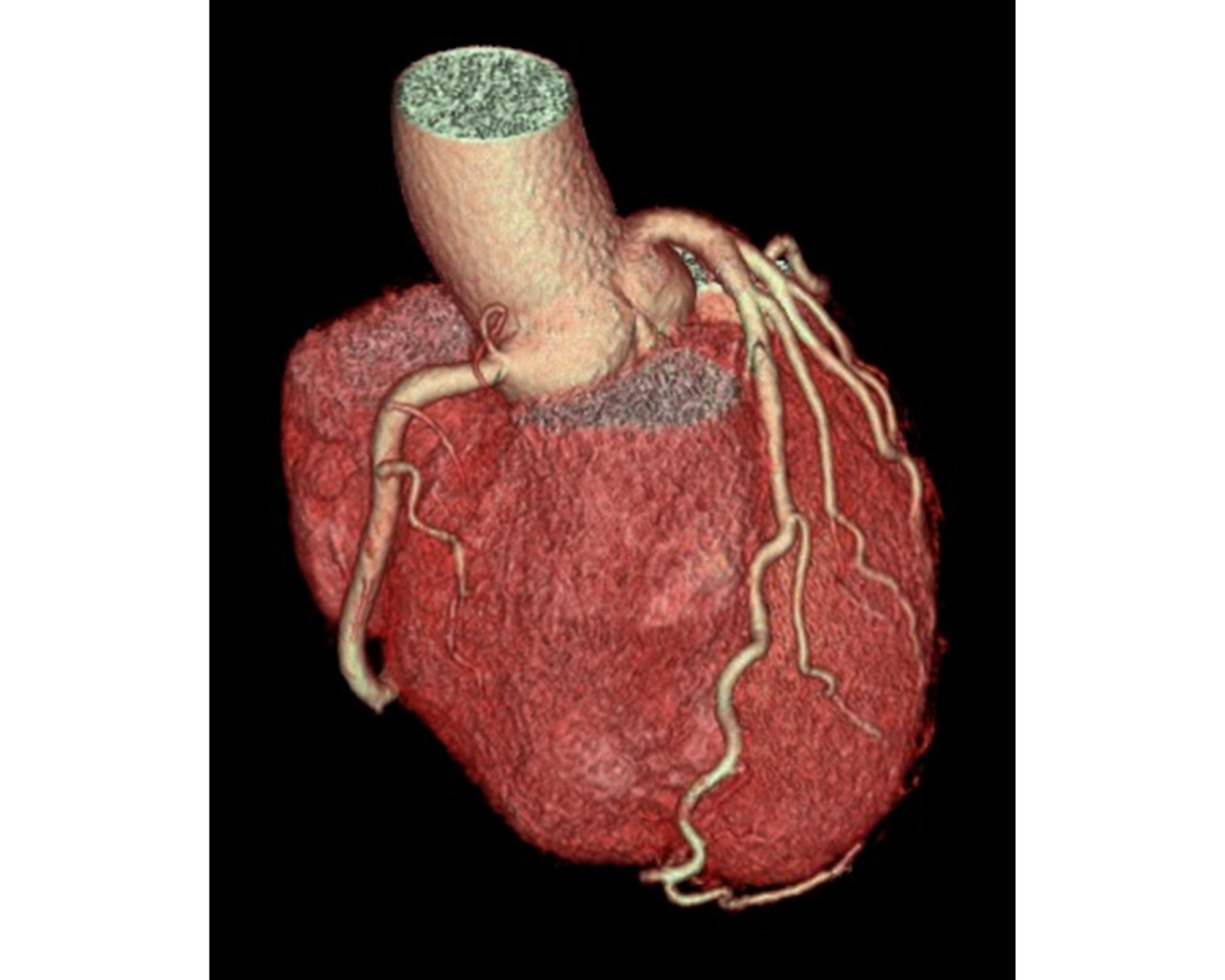 冠動脈3D画像