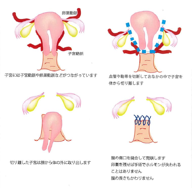 腹腔鏡下子宮全摘出術