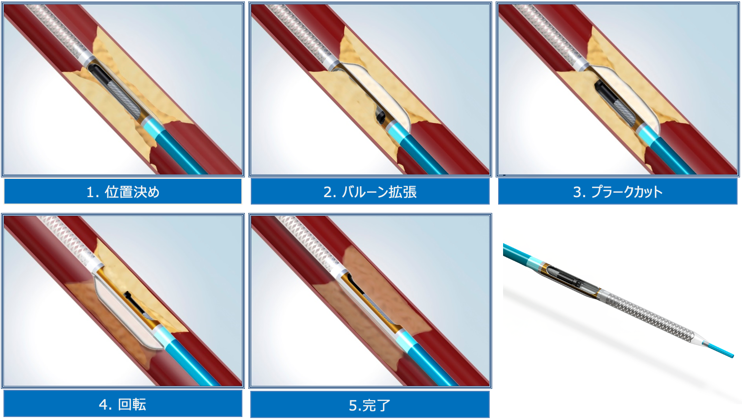 DCA（方向性冠動脈粥腫切除術）