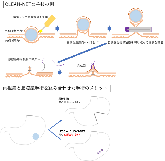 CLEAN-NETの手術の例