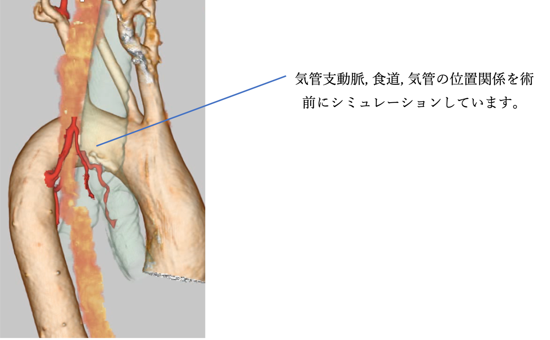 術前シミュレーション