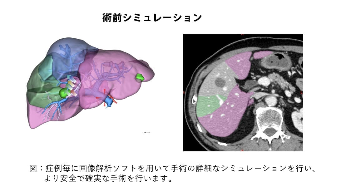 術前シュミレーション