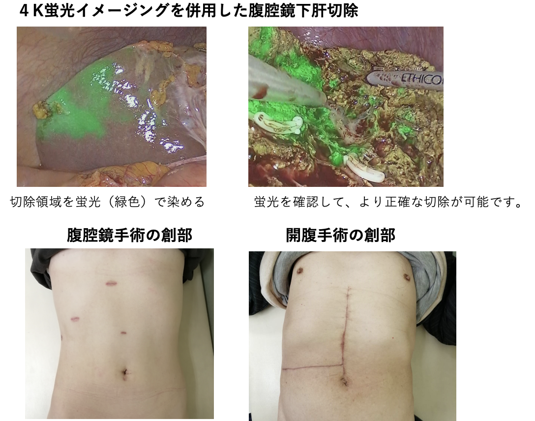 4K蛍光イメージングを併用した腹腔鏡下肝切除