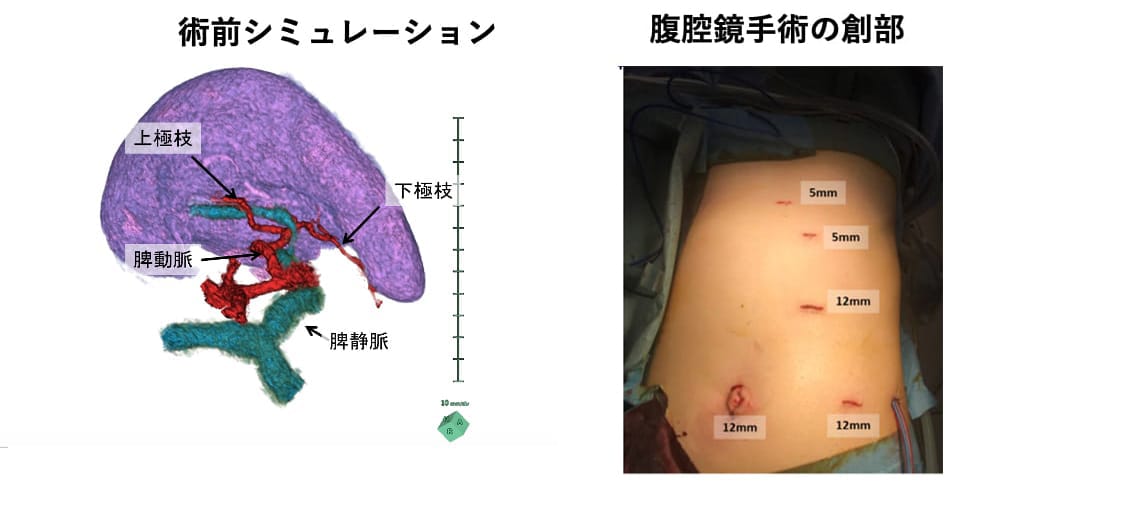 腹腔鏡下脾摘出（切除）術