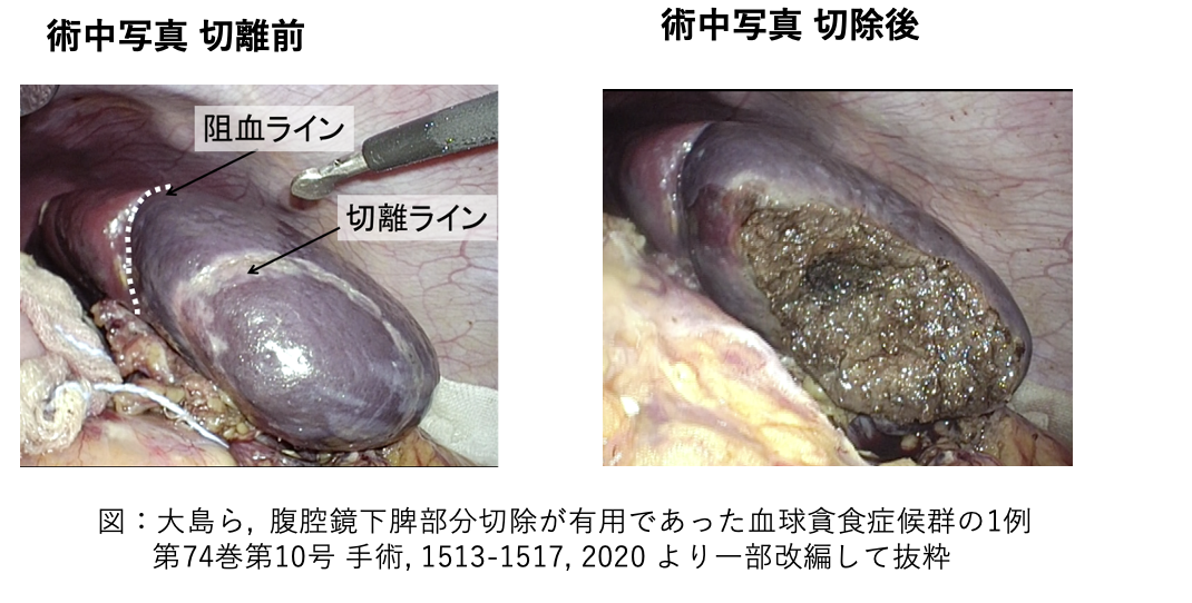 腹腔鏡下脾摘出（切除）術