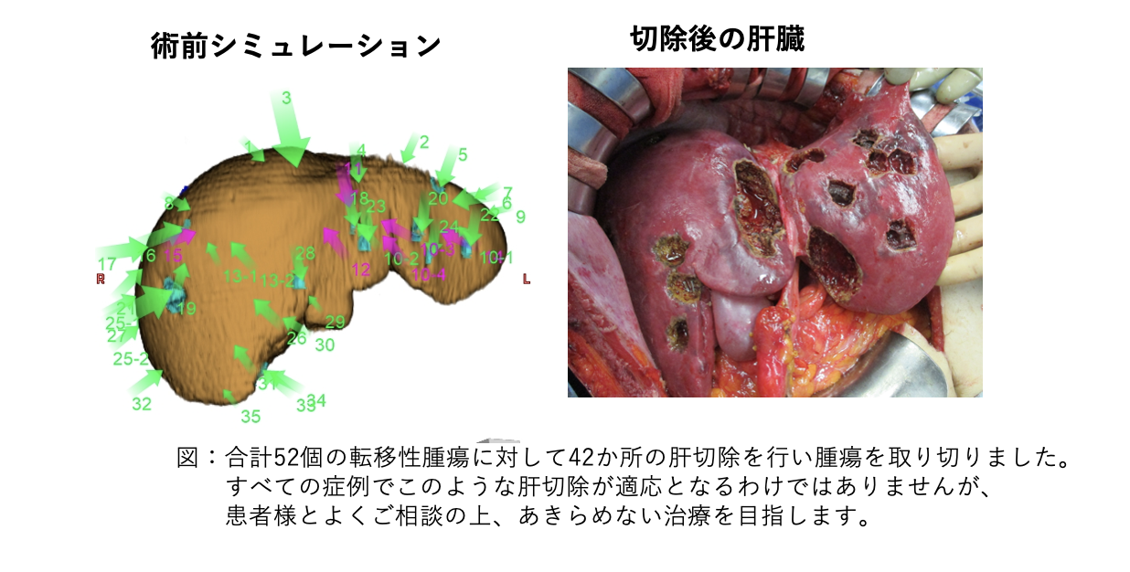 転移性肝腫瘍（肝転移）