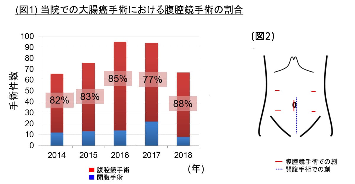 腹腔鏡手術の施行