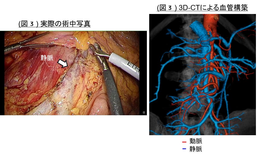 ３D-CTを用いた術前プランニング