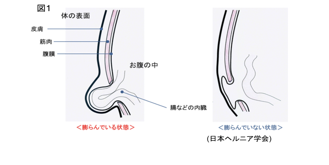 鼠径ヘルニアの病態