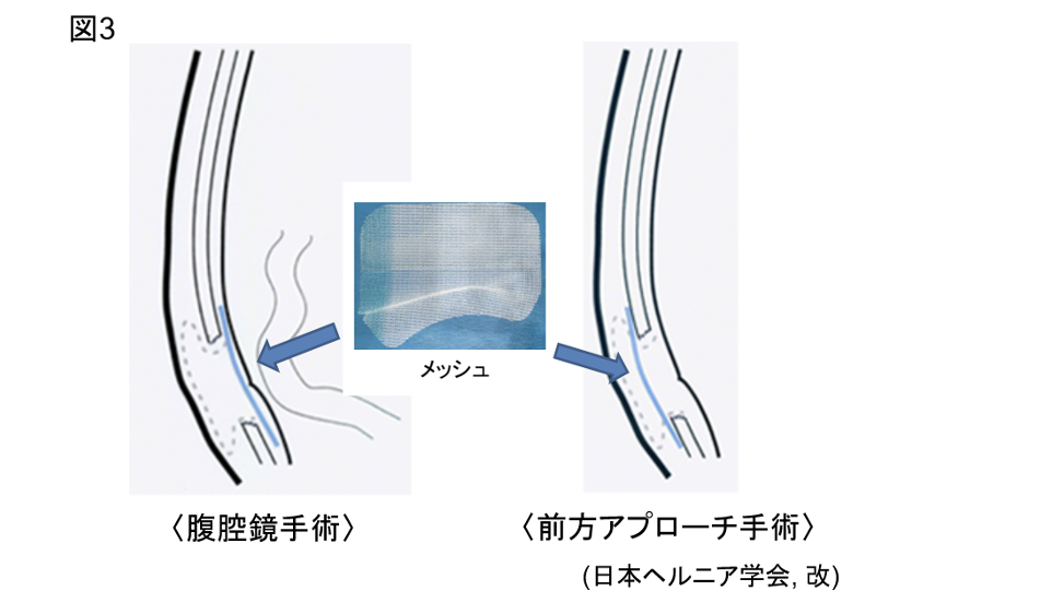 鼠径ヘルニアに対する手術療法