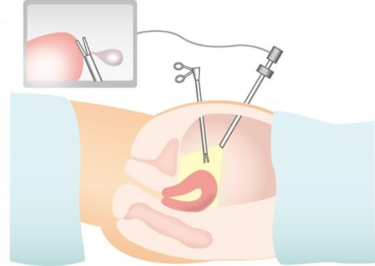婦人科内視鏡手術について